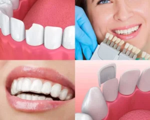 Permanent Dentures odessa