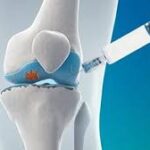 Viscosupplementation Market