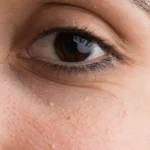 bumps under eyes