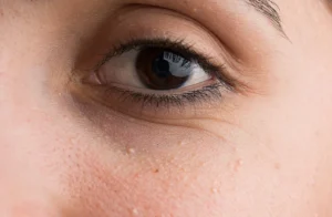 bumps under eyes