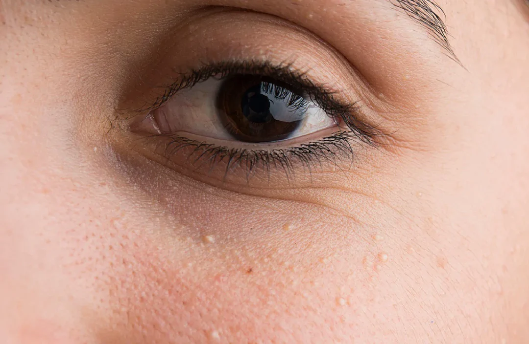 bumps under eyes