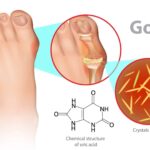 Uric Acid