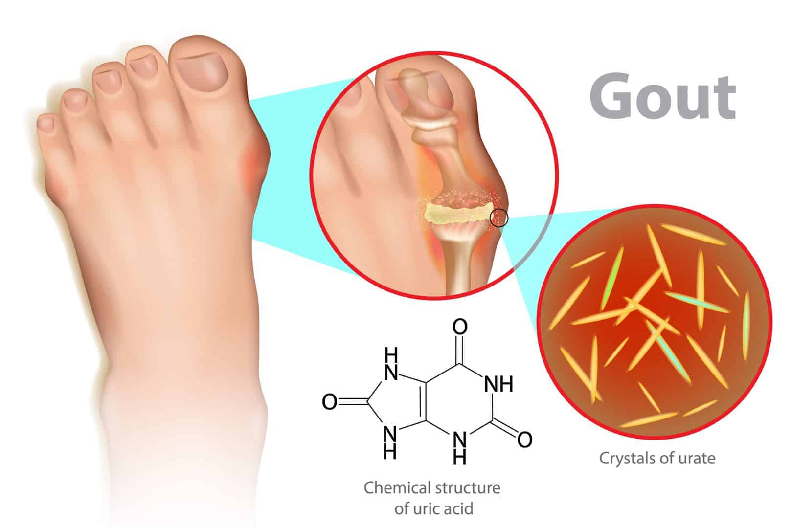 Uric Acid