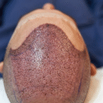 Hair Transplant in Riyadh
