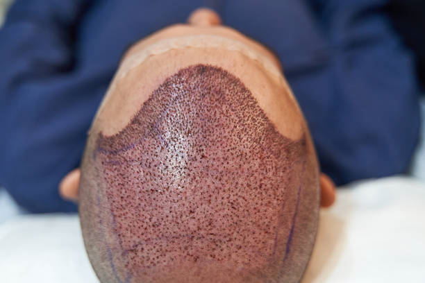 Hair Transplant in Riyadh