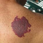 Birthmarks Removal Treatment in Dubai