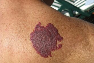 Birthmarks Removal Treatment in Dubai