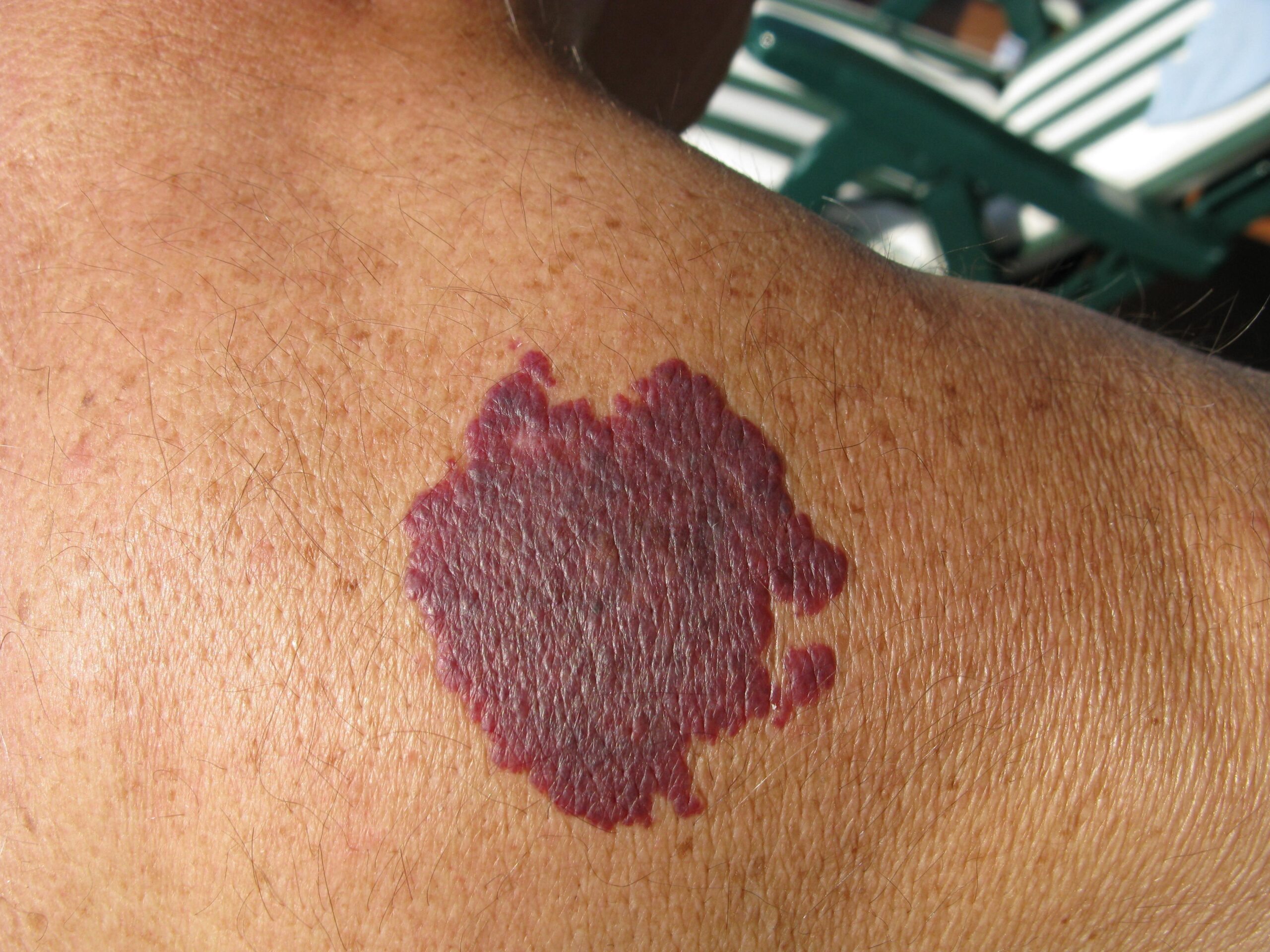 Birthmarks Removal Treatment in Dubai