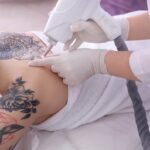 Laser Tattoo Removal in Dubai