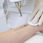 Laser Tattoo Removal in Dubai