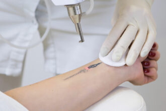 Laser Tattoo Removal in Dubai