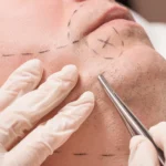 Mustache Hair Transplantation