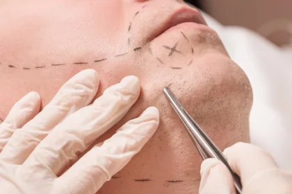Mustache Hair Transplantation