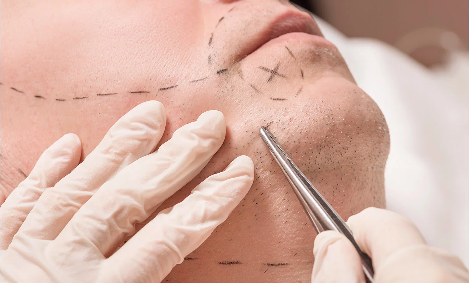 Mustache Hair Transplantation