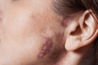 Birthmarks Removal Treatment in Dubai