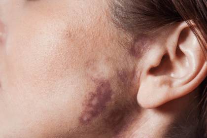 Birthmarks Removal Treatment in Dubai