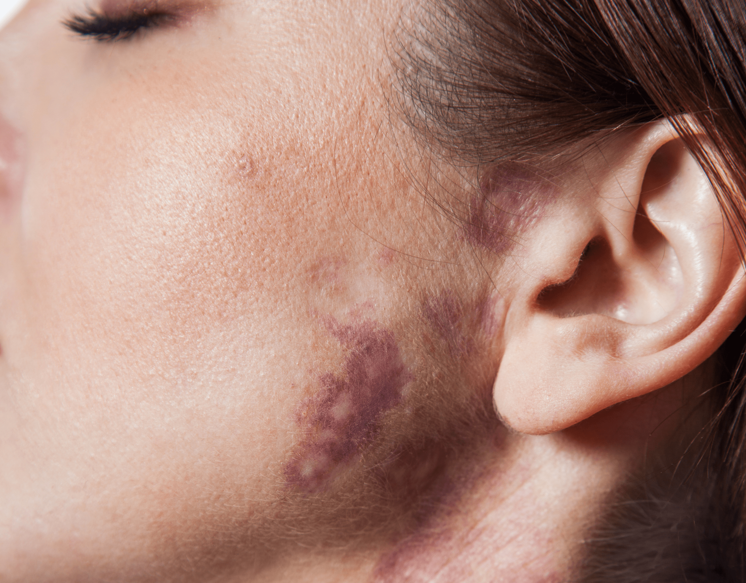 Birthmarks Removal Treatment in Dubai