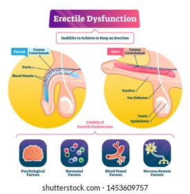 Erectile dysfunction (ED) affects millions of men worldwide, interfering with intimate relationships and self-confidence.