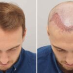 Hair Transplant in Riyadh | Natural Results by Experts