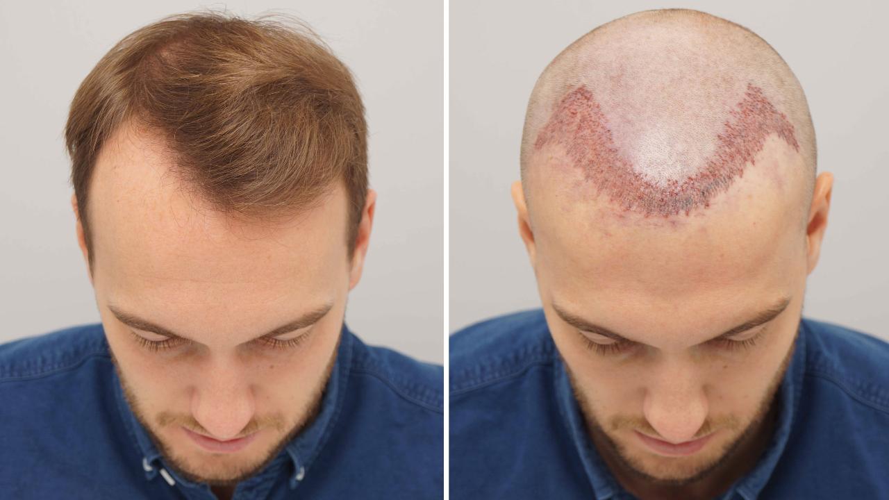 Hair Transplant in Riyadh | Natural Results by Experts