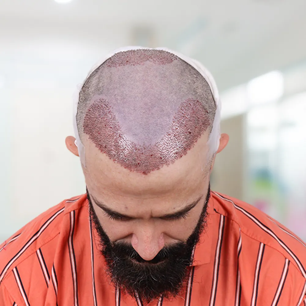 Hair Transplant in Dubai