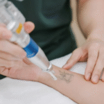Laser Tattoo Removal in Dubai