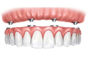 Implantologia dentale Albania