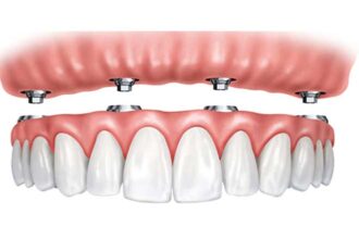 Implantologia dentale Albania