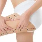 Liposuction in Riyadh