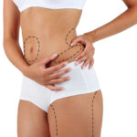 Liposuction in Riyadh